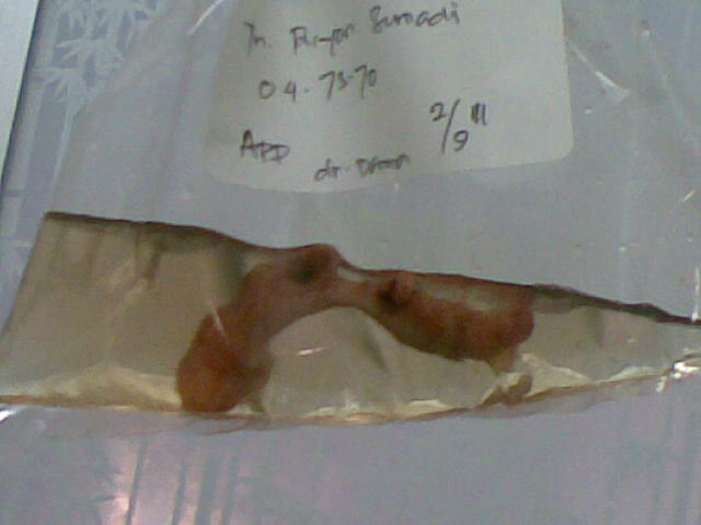 My appendix from another view