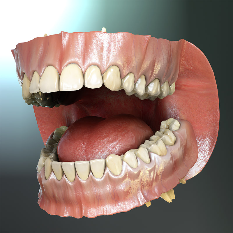 Открытая полость рта. Бисфосфонатный некроз челюсти.