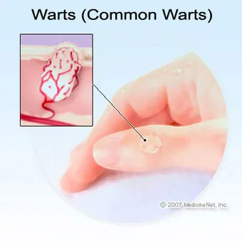 warts-s1-facts.jpg